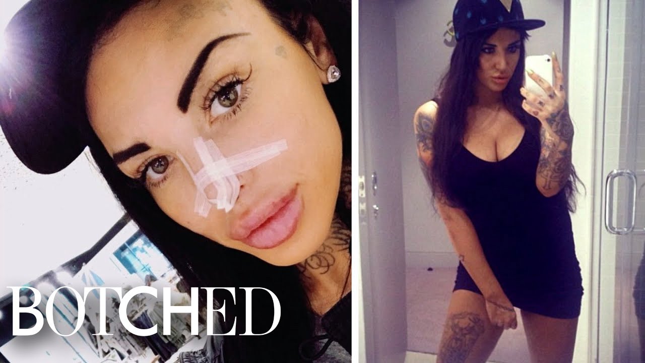 3 Nose Jobs Give "Botched" Patient the "Worst Nose Ever" | Botched | E!