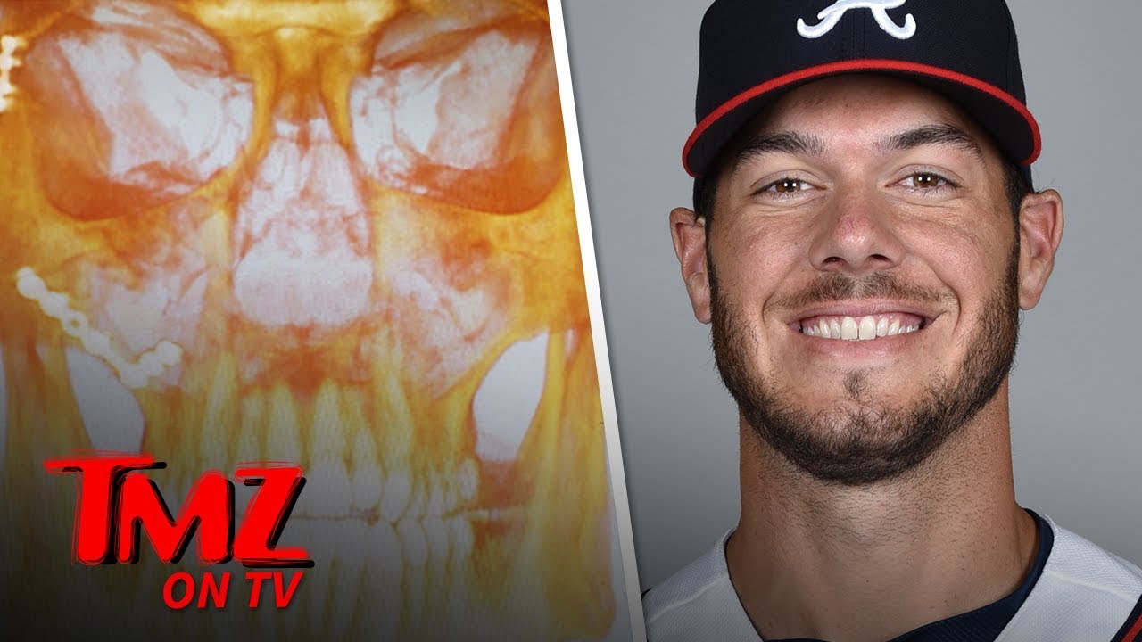 MLB's Josh Ravin Shows X-Ray After Line Drive to Face | TMZ TV 1