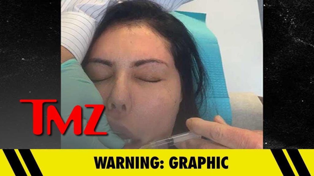 Liziane Gutierrez's Plastic Surgery Nightmare is Getting Worse | TMZ 1