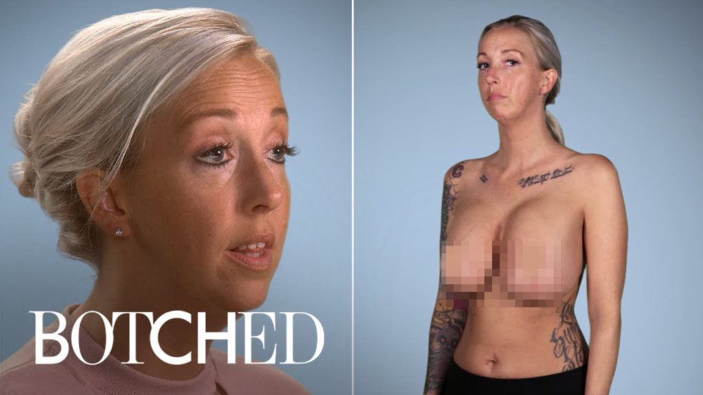 Upside Down Zucchini Breasts Need Fixing | Botched | E! 1