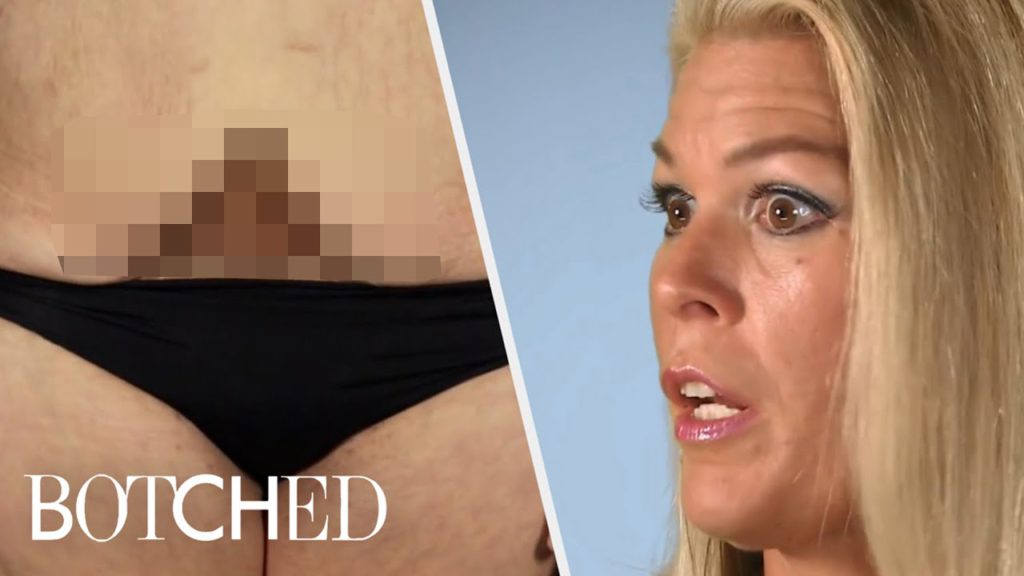 Tummy Tuck Surgeries Gone Wrong | Botched | E! 1