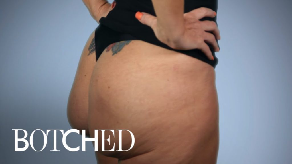 Butt Implants Gone Completely Wrong | Botched | E! 1