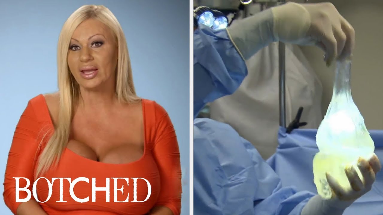 Botched And Its Most Intense Breast Implant Surgeries | E! 3