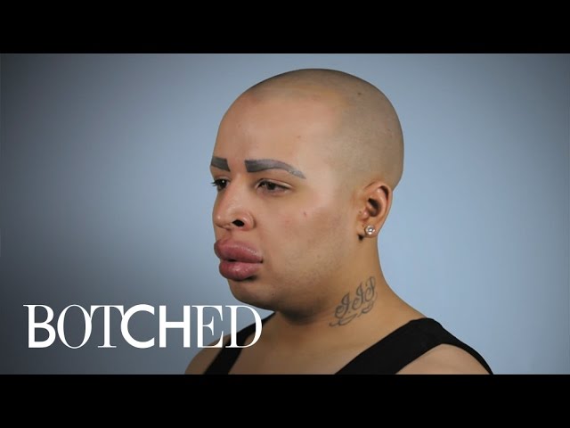 Can "Botched" Doctors Help Patient With Ginormous Lips? | E! 5