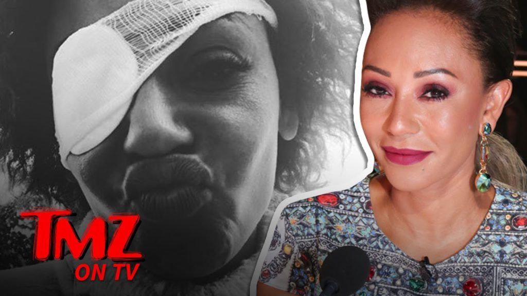 Mel B Sets Story Straight About Eye Problems | TMZ TV 1